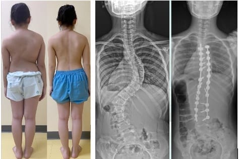 กระดูกสันหลัง ภาพแสดงวัยรุ่นก่อนและหลังการผ่าตัดแก้ไขภาวะกระดูกสันหลังคด ออร์โธปิดิกส์