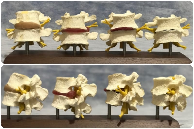 กระดูกสันหลัง แบบจำลองกระดูกสันหลังส่วนเอวแสดงหมอนรองกระดูกสันหลังเสื่อมสภาพ ออร์โธปิดิกส์