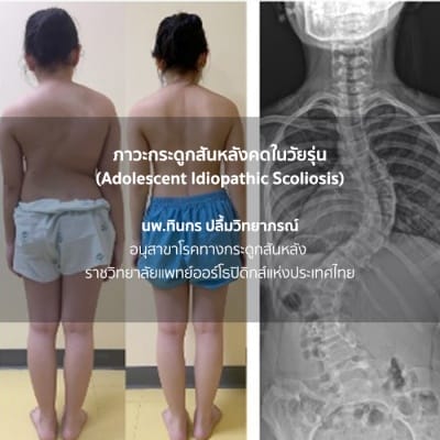 กระดูกสันหลัง ภาวะกระดูกสันหลังคดในวัยรุ่น: ภาพแสดงสรีระและเอ็กซ์เรย์กระดูกสันหลังคด ออร์โธปิดิกส์