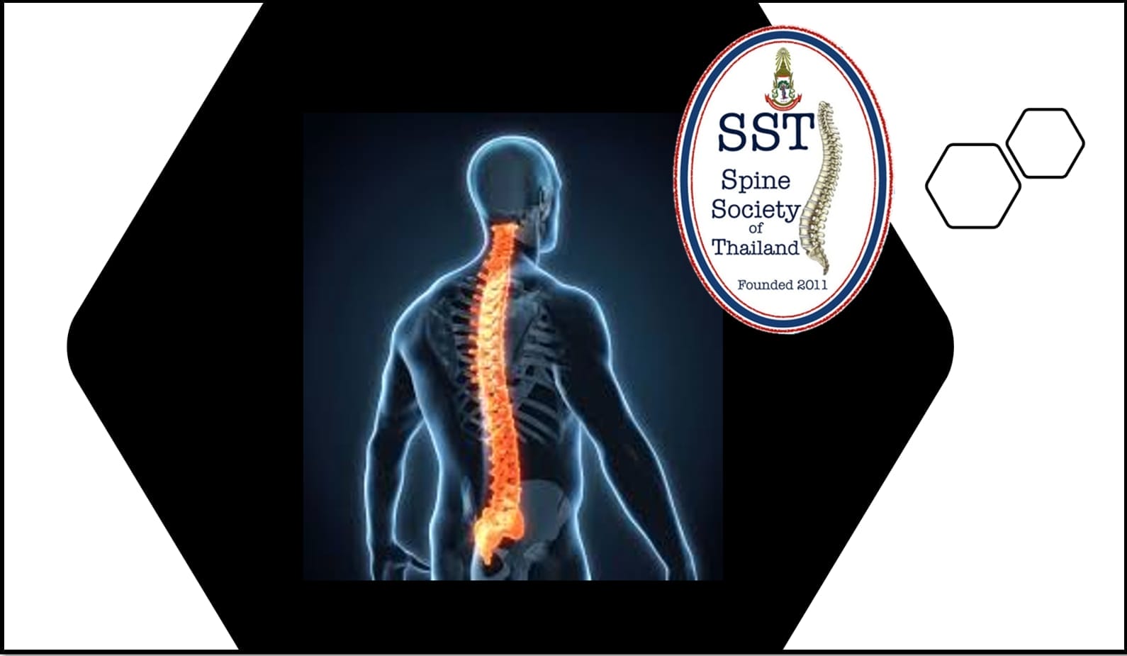 กระดูกสันหลัง ภาพกระดูกสันหลังมนุษย์ โลโก้ SST Spine Society of Thailand ชวนสมัครสมาชิก ออร์โธปิดิกส์
